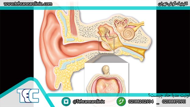 عفونت گوش میانی یا اوتیت سروز چیست؟ علائم و درمان آن کلینیک گوش تهران