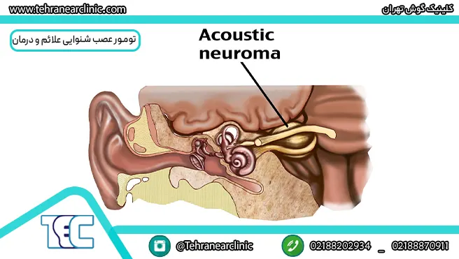 تومور عصب شنوایی (نوروم آکوستیک) علائم و درمان