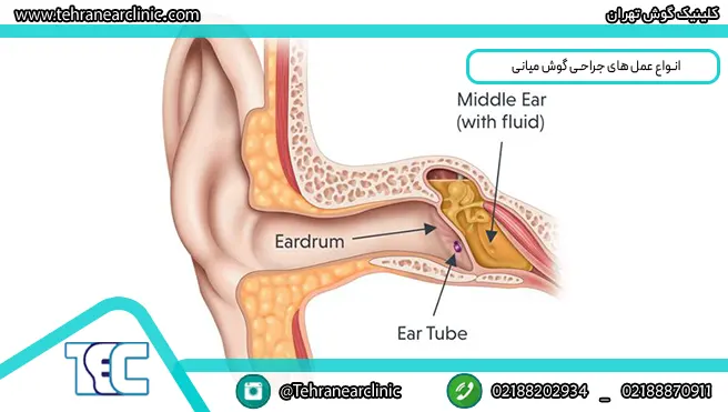 شایع‌ترین انواع عمل‌های جراحی گوش میانی