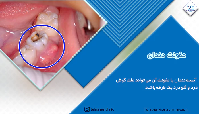 عفونت دندان از دلایل رایج گوش درد و گلو درد یکطرفه