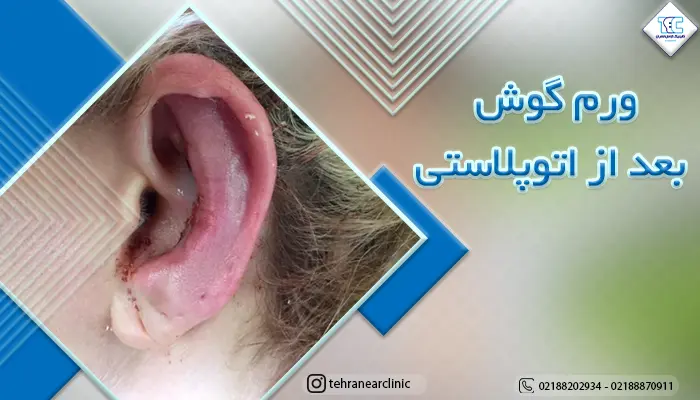 ورم گوش بعد از اتوپلاستی: علت و درمان تورم بعد از جراحی زیبایی گوش