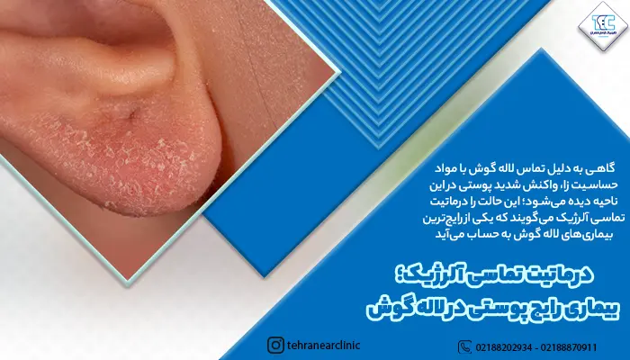 درماتیت تماسی آلرژیک؛ بیماری رایج پوستی در لاله گوش