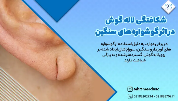 شکافتگی لاله گوش در اثر گوشواره‌های سنگین