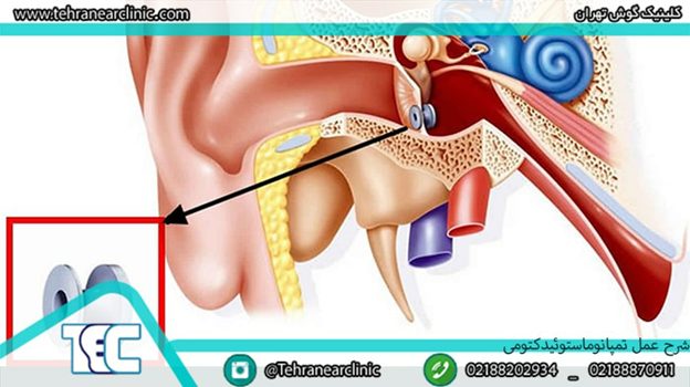 تصویر داخل گوش و میرنگتومی