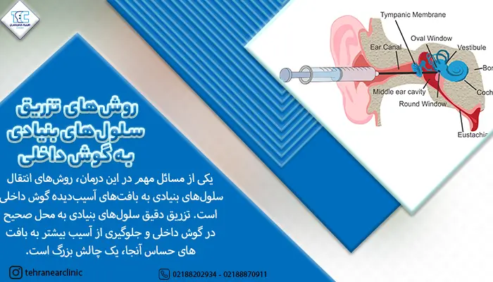 تصویر تزریق سلول های بنیادی داخل گوش برای درمان کم شنوایی