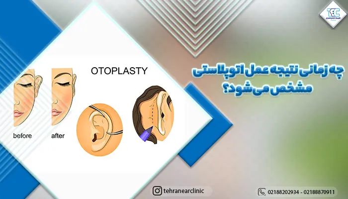 تصویر قبل و بعد عمل آتوپلاستی برای نشان دادن نتیجه عمل اتوپلاستی