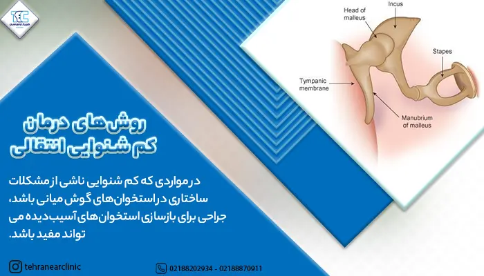 تصویر اجزا گوش داخلی و توضیح روش های درمان کم شنوایی انتقالی