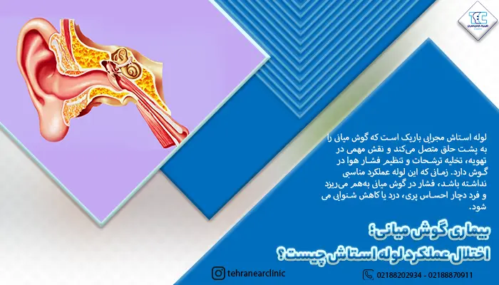 تصویر اختلال عملکرد لوله استاش 