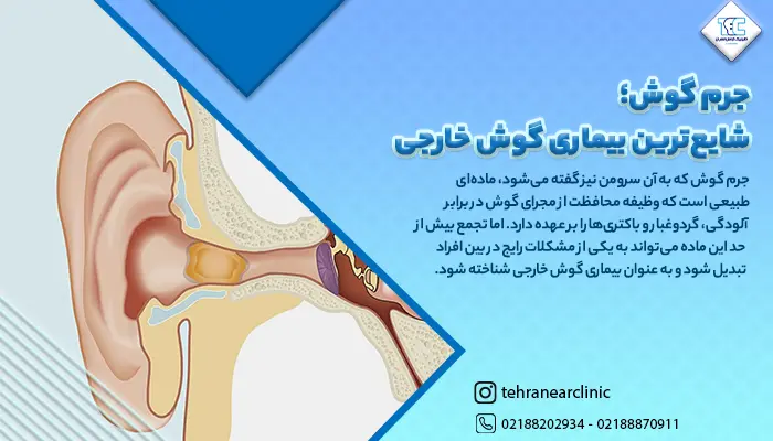 تصویر جرم گوش یکی از بیماری های شایع گوش