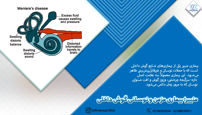 گوش داخلی و نشانه های بیماری منییر در گوش داخلی