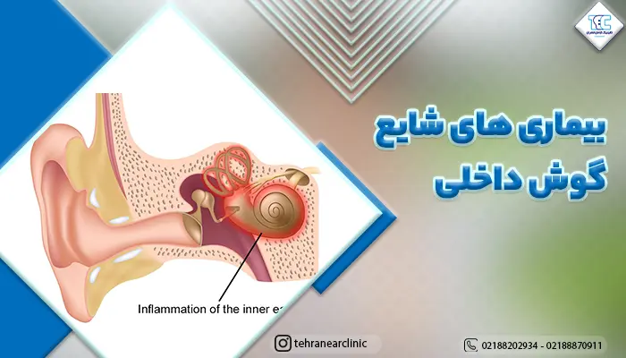 تصویر گوش داخلی و بیماری های شایع گوش داخلی