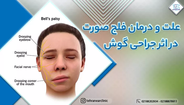 علت و درمان فلج صورت در اثر جراحی گوش